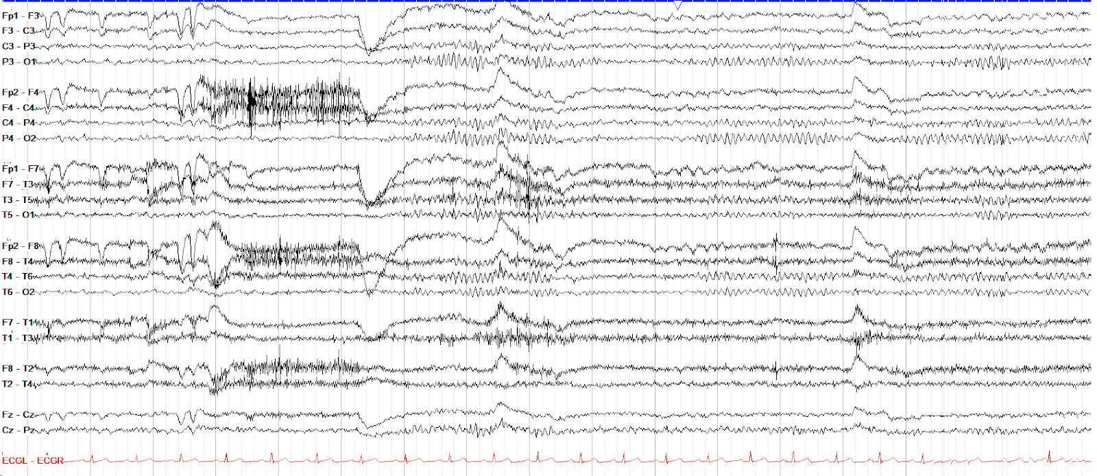 The Normal Awake EEG